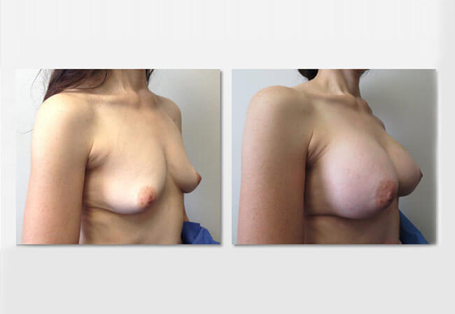 Breast Augmentation Case 4 right side view