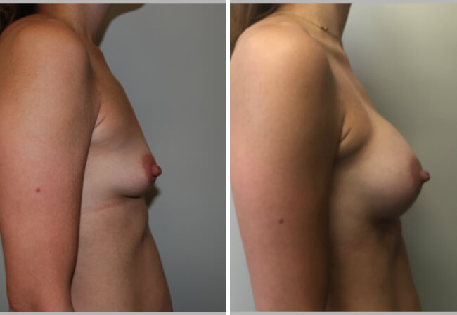 Breast Augmentation Case 3, right profile view