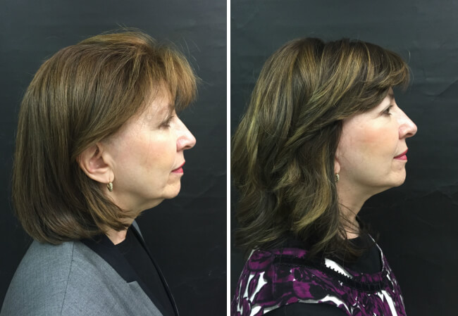 Facelift, Upper Lid Blepharoplasty - case 1 right profile view