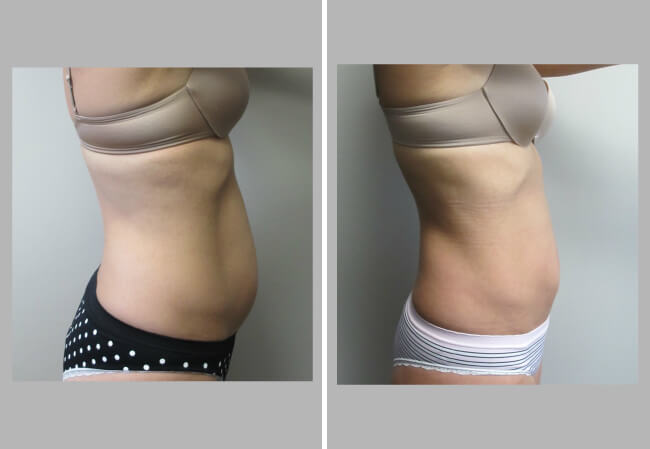 Liposuction Case 1 right profile view