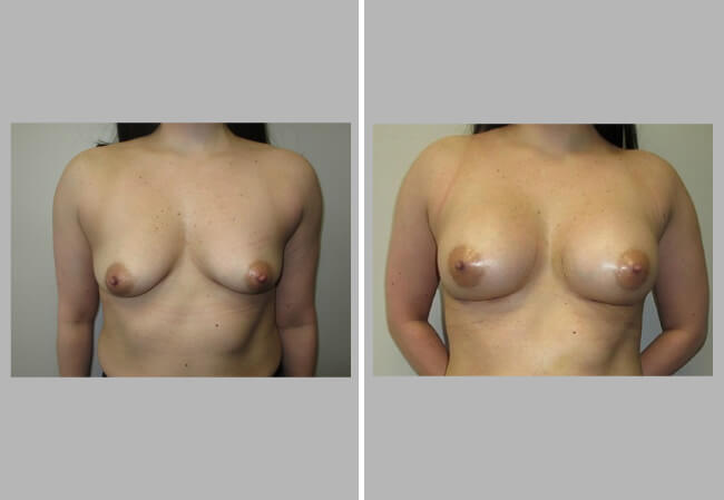 Breast Augmentation case 2 front view