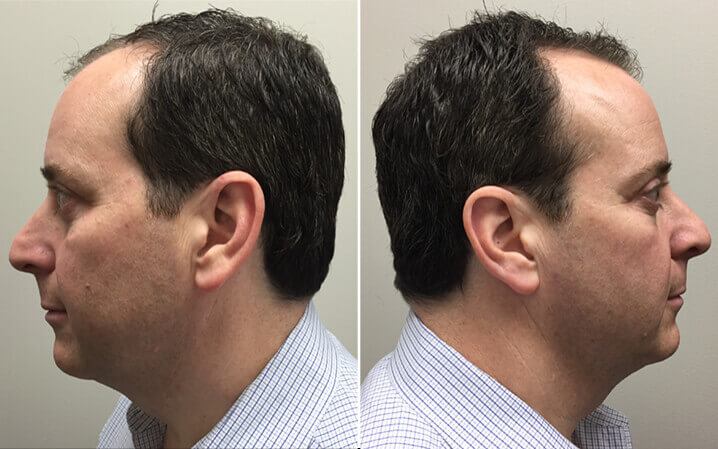 Lower Blepharoplasty, left and right side view