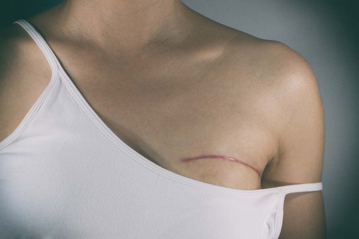 woman after mastectomy