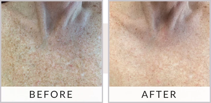 Before and after photo of Sciton Joule Laser treatment